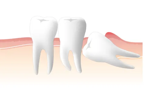 歯胚抜歯(しはいばっし)