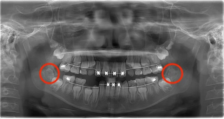 施術前レントゲン写真