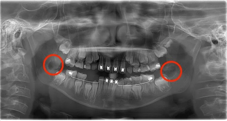 施術後レントゲン写真