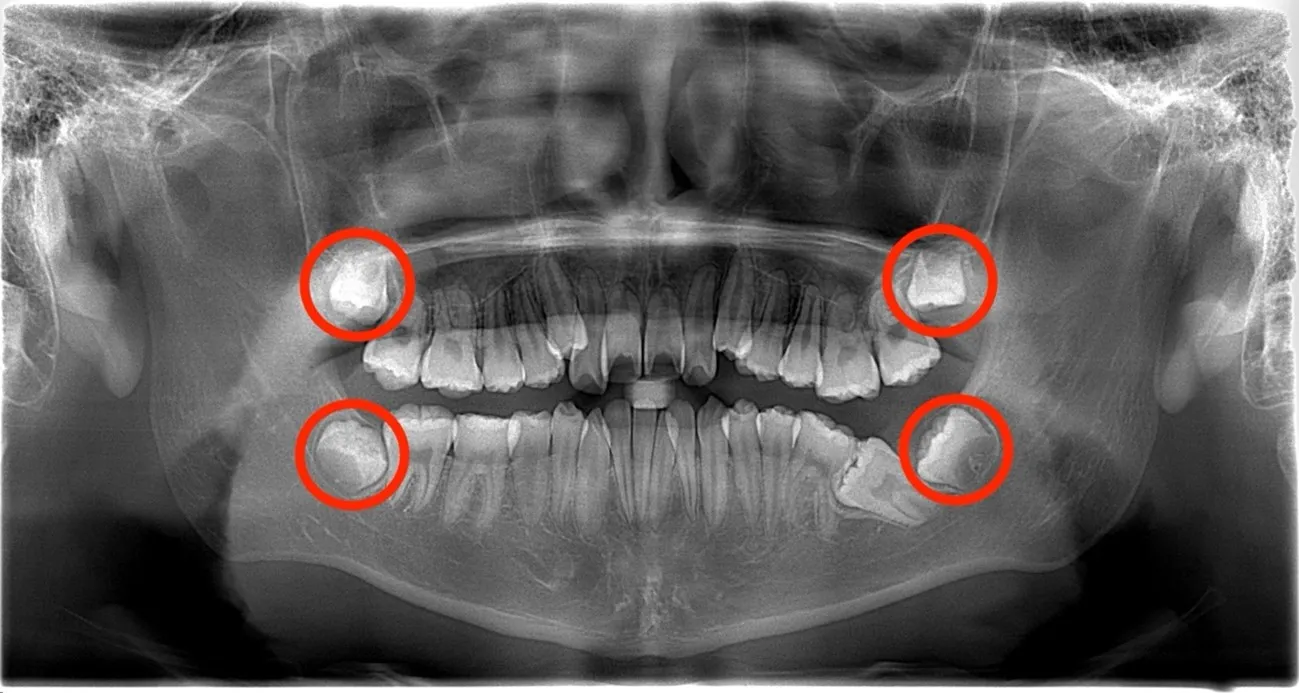 歯列不正レントゲン写真