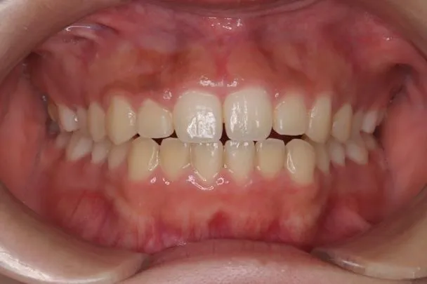 ガミースマイル症例①Before