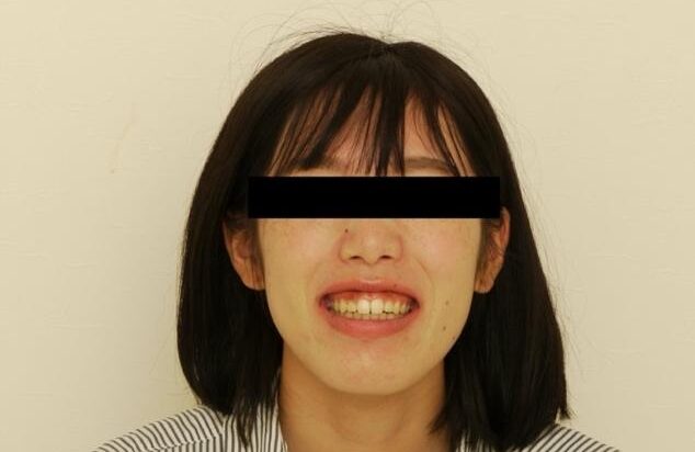 ガミースマイル症例①Before