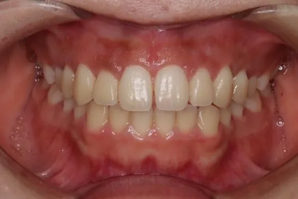 ガミースマイル症例①AFTER