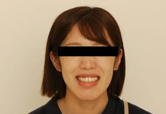 ガミースマイル症例①AFTER