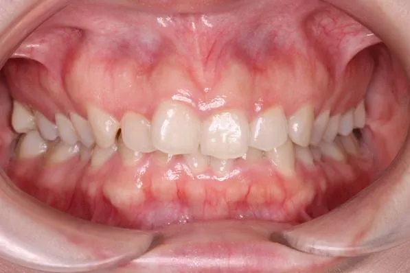 ガミースマイル症例②Before