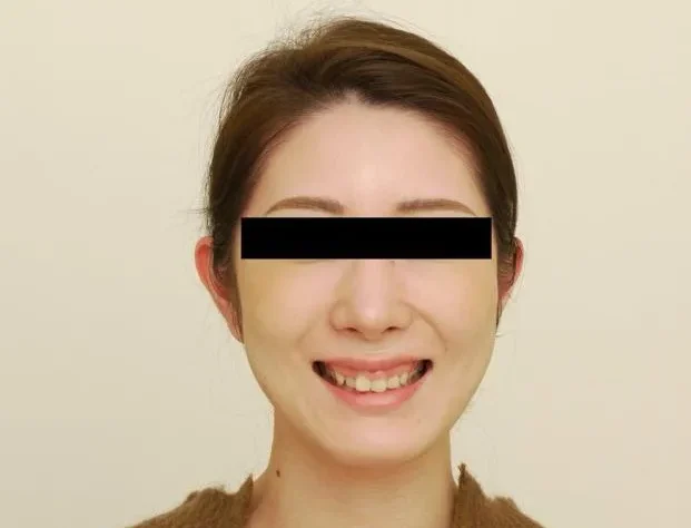 ガミースマイル症例②Before