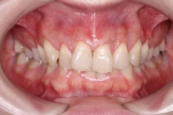 ガミースマイル症例②After