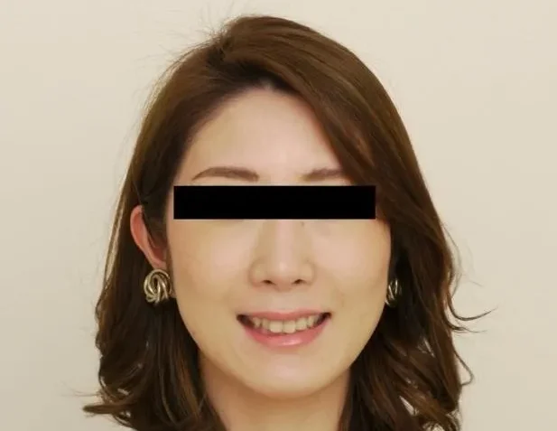 ガミースマイル症例②After