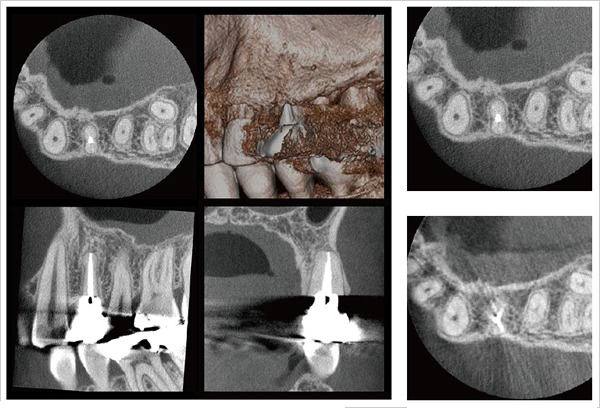 歯科用CTについて