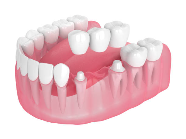 3d render of jaw with dental bridge  over white background