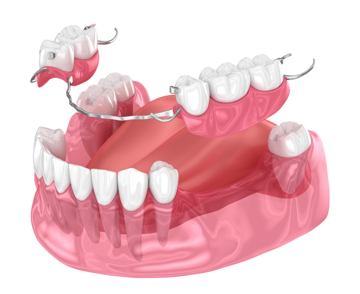 Removable partial denture, mandibular prosthesis. Medically accurate 3D illustration of prosthodontics concept